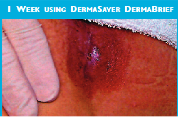 DermaBrief™ Pull Up - DB1300