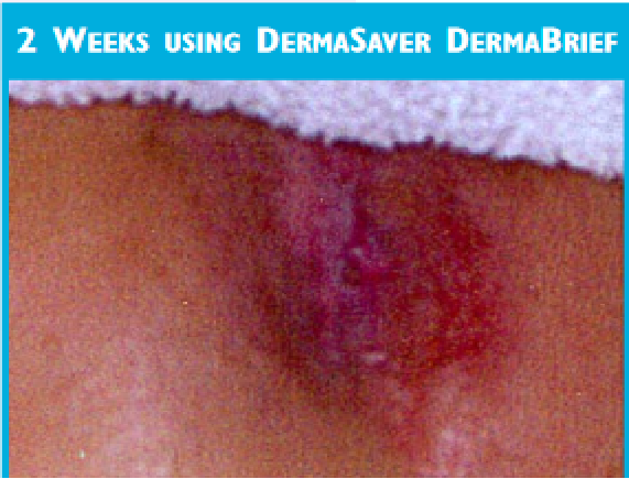 DermaBrief™ Pull Up - DB1300
