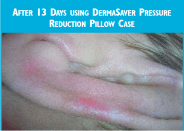 Pressure Reduction Pillowcase - PC1300