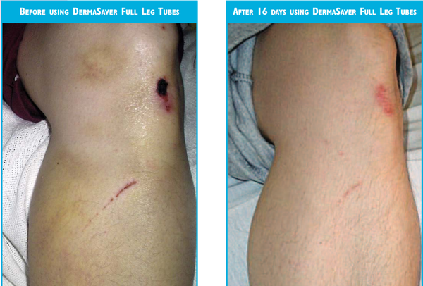 Leg Tube - LT1300