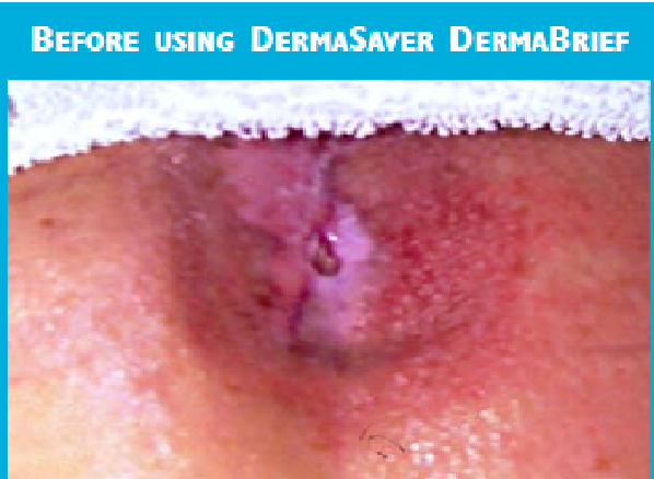 DermaBrief™ Pull Up - DB1300