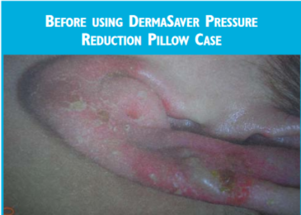 Pressure Reduction Pillowcase - PC1300